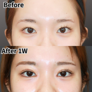 二重埋没法とスキンリドレープ法の症例、術前と1週間後