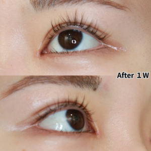 二重埋没法とスキンリドレープ法の目元アップ