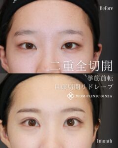 二重全切開+眼瞼下垂+スキンリドレープ法の症例、1ヶ月後