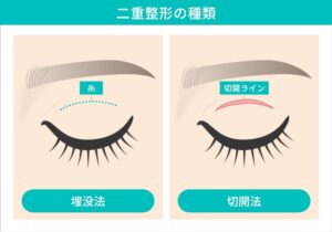 二重整形の種類：埋没法と切開法を比較