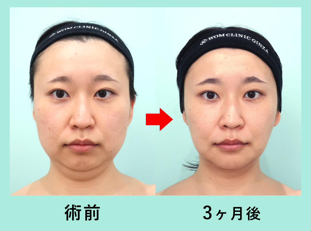 『輪郭3点骨切り× 脂肪吸引で圧倒的変化を!』の画像