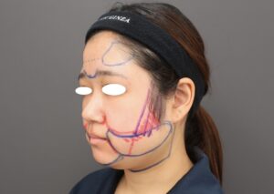 『『小顔/輪郭形成』上・下顔面へのトータルアプローチで理想の輪郭に。』の画像