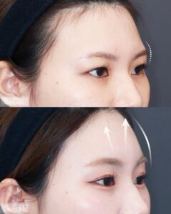 内視鏡額挙上＋アイホールボーン削りのビフォーアフター01