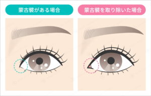 目頭の蒙古襞がある場合と取り除いた場合