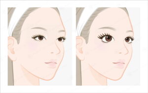 アイホールボーン削りのビフォーアフターを比較するイラスト