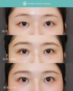 施術前後の目の比較画像