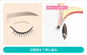 縫合跡のまぶた表面と断面図