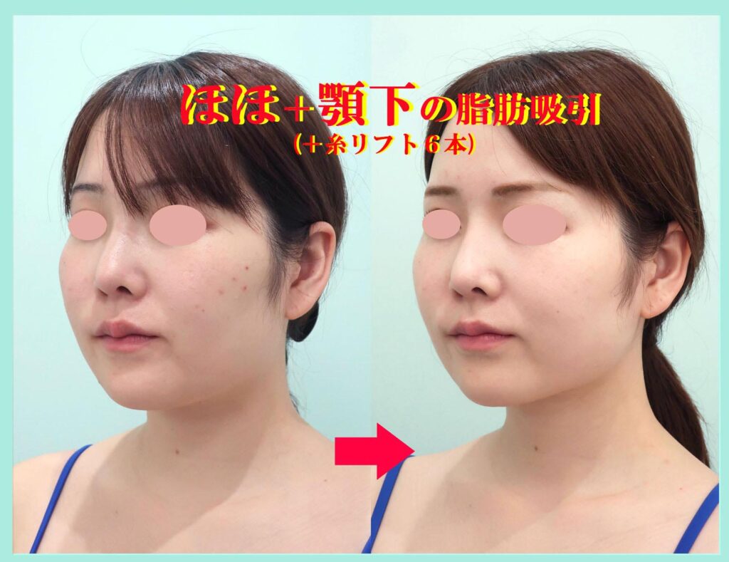 『こんなに綺麗なフェイスラインになる、私の「頬+顎下」のベイザー脂肪吸引』の画像