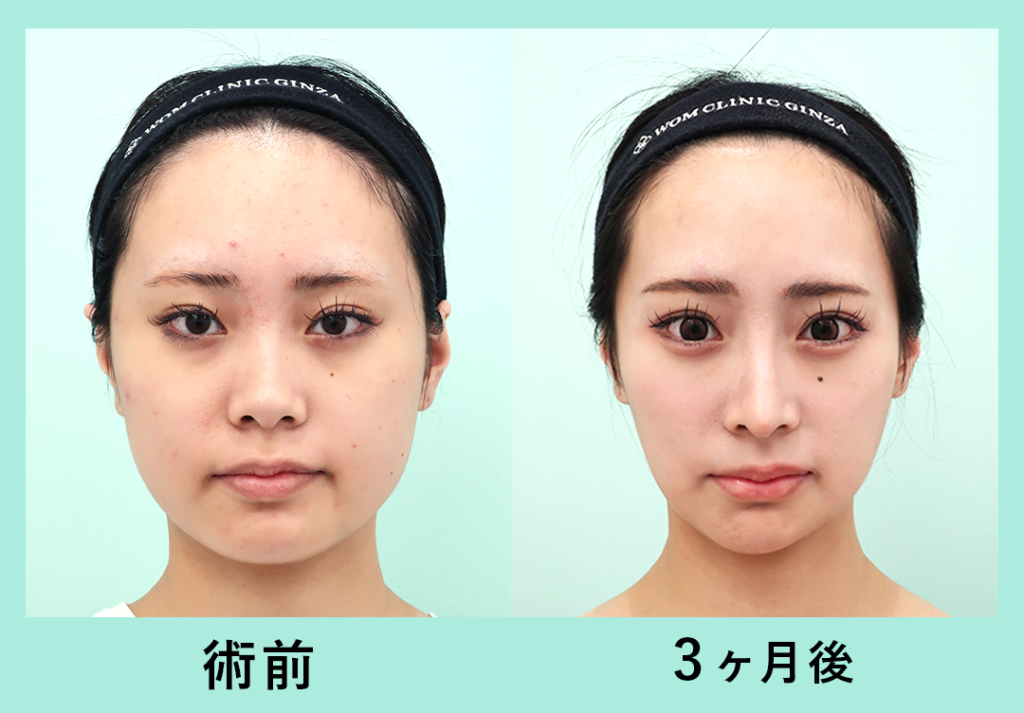 『圧倒的変化量!輪郭3点+脂肪吸引』の画像