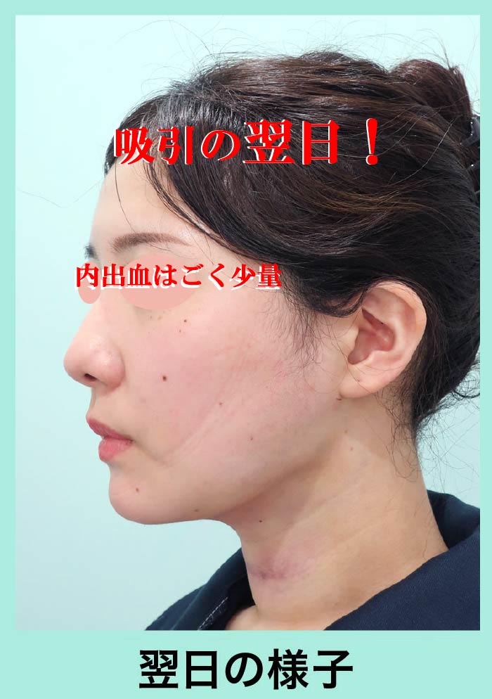 小顔吸引手術後翌日写真