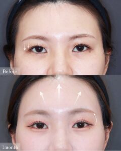 女性の目元アップ、1ヶ月後比較