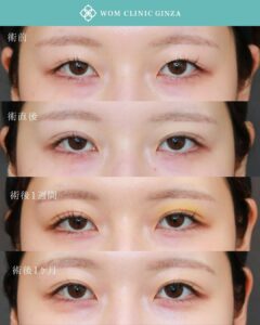 女性の術前、直後、1週間後、1ヶ月後の目元比較