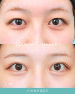 整形前後の女性の目元比較