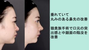 術前と術後の女性の横顔比較、鼻と口元を改善