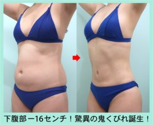 腹部全体+胸下+腰+背中下の脂肪吸引ビフォーアフター