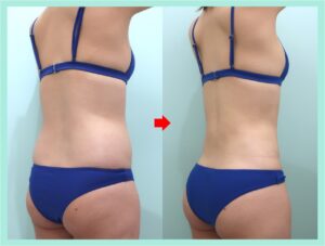腹部全体＋胸下＋腰＋背中下の脂肪吸引の症例