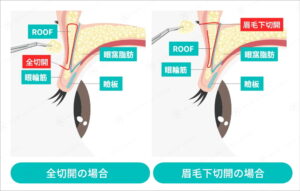全切開と眉毛下切開併用の比較図