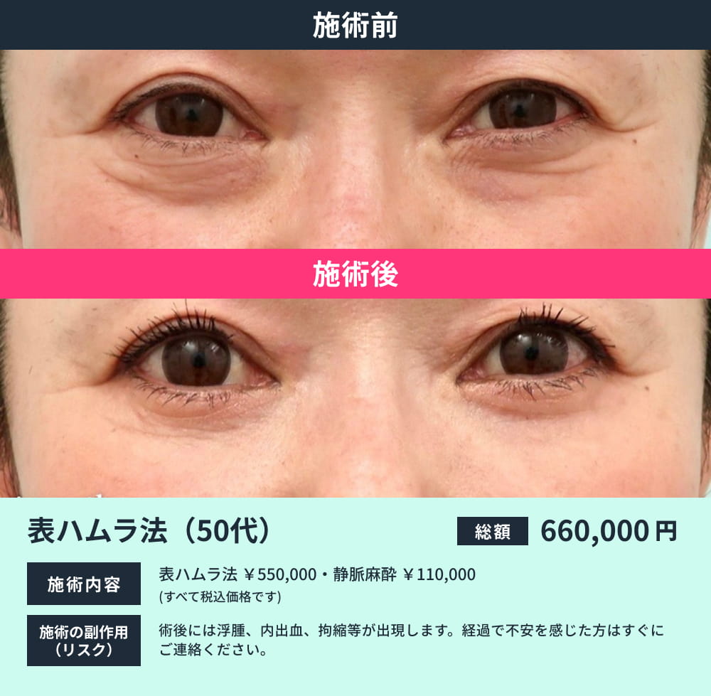 表ハムラ(50代)のビフォーアフター