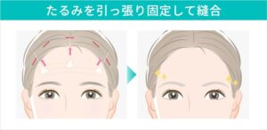 切開部を固定・縫合している図