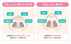 日本人の鼻と外国人の鼻の軟骨・脂肪・皮膚の構造比較