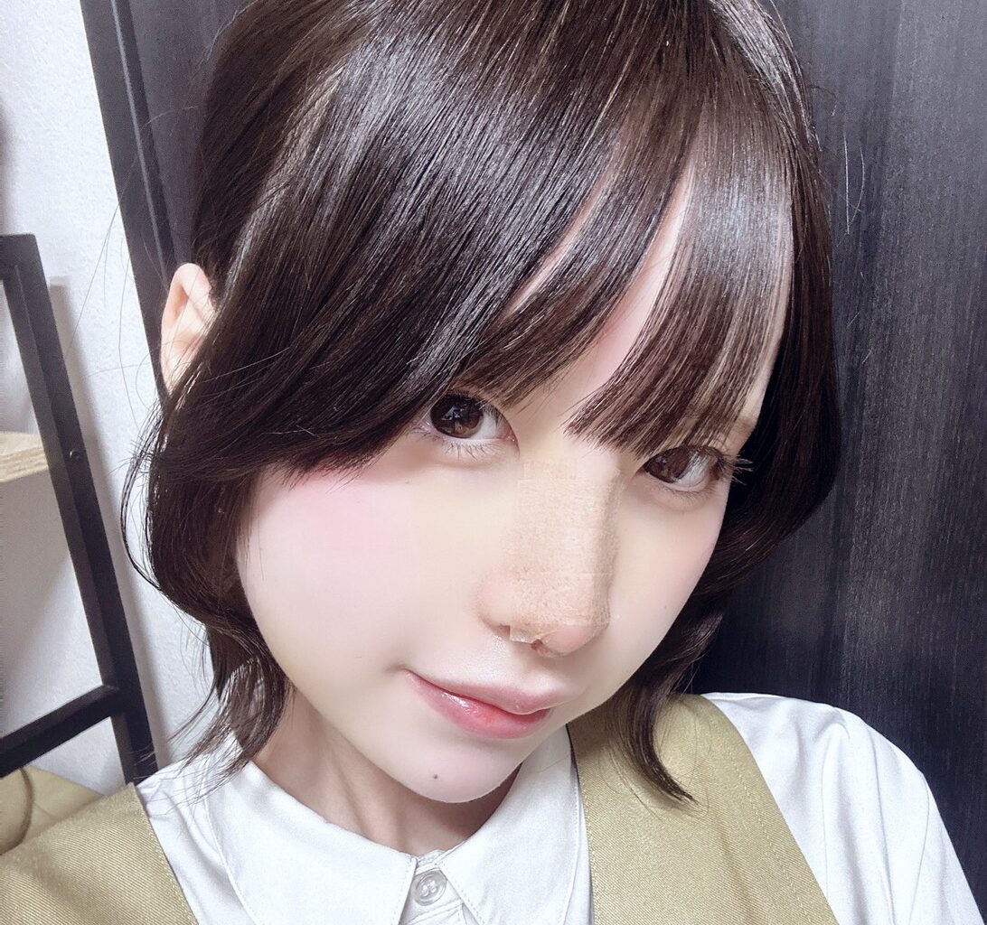 鼻フルで口元の突出感解消! AFTER写真