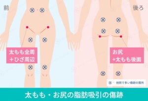 脂肪吸引の傷跡を示した図
