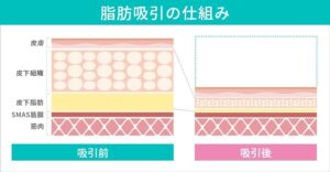 脂肪吸引前後の皮膚断面図比較