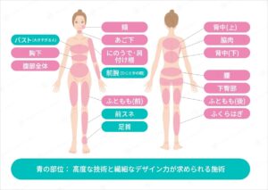 脂肪吸引可能部位を示す図