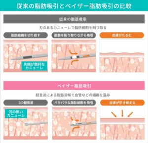 脂肪吸引とベイザー脂肪吸引の比較図