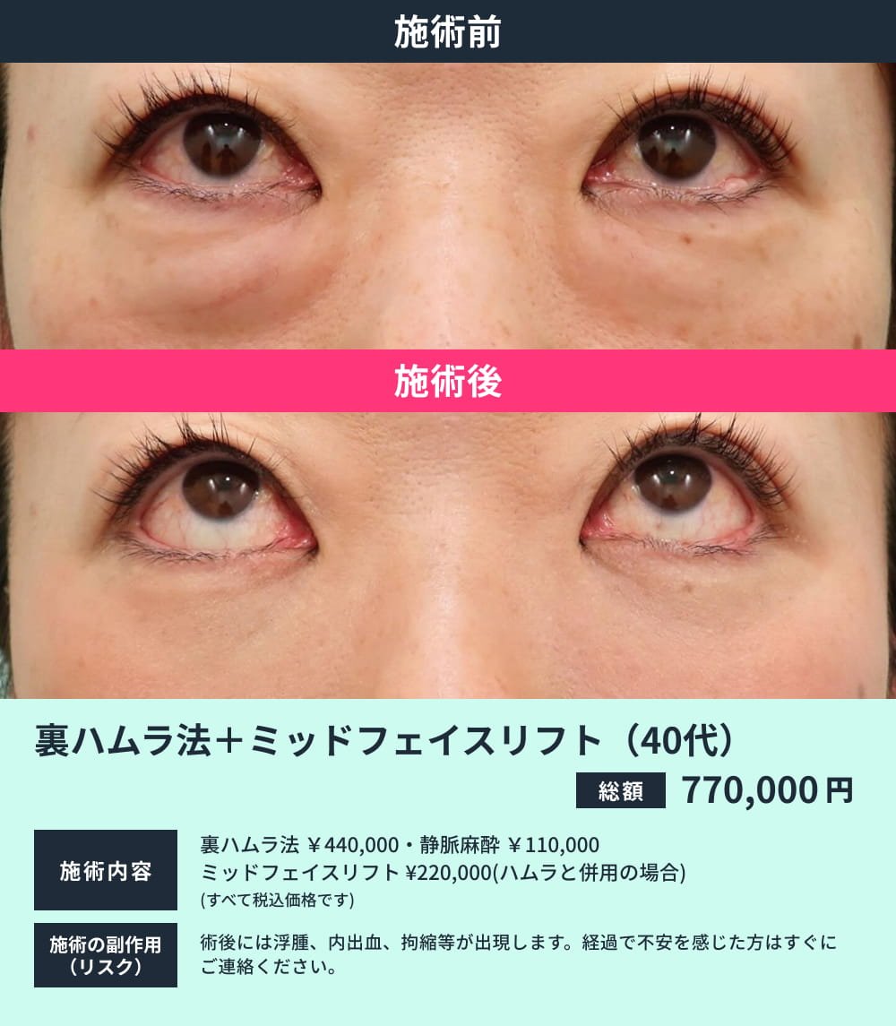 裏ハムラ+ミッドフェイスリフト(40代)のビフォーアフター