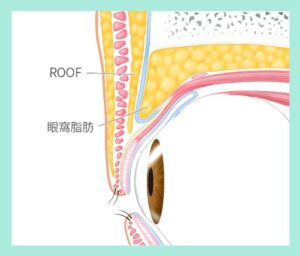 眼窩脂肪と上眼瞼の断面図