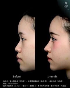 鼻の整形前と1ヶ月後の女性の横顔比較