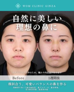 鼻整形ビフォーアフター、1週間後の女性