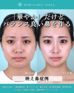 鼻整形前後の女性の顔比較、3ヶ月後