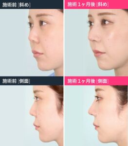 鼻整形前後の女性の顔の比較01