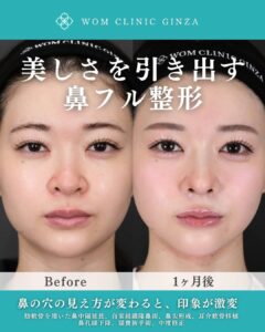 鼻整形術前後の女性の顔比較02