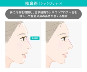 隆鼻術前後の横顔の比較