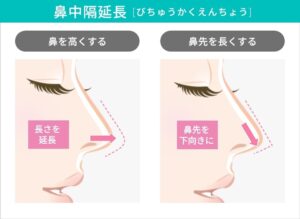鼻中隔延長術の比較図：鼻を高く、鼻先を長く