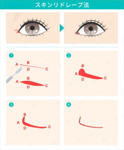 目頭切開のスキンリドレープ法の術式図解