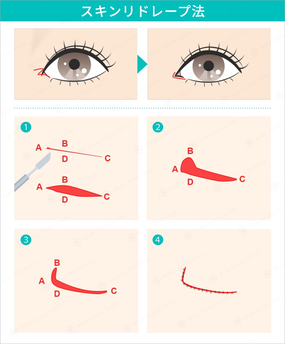 目頭切開のスキンリドレープ法の術式図解