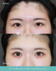 眉下切開+ROOF切除+目頭切開のビフォーアフター