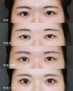 眉下切開+ROOF切除+目頭切開の症例の経過