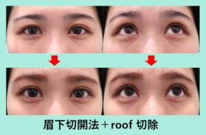 眉下皮膚切除+ROOF切除のビフォーアフター