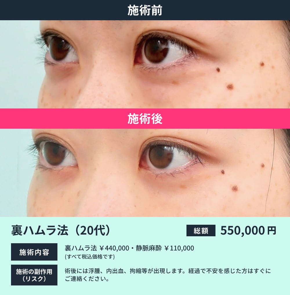 裏ハムラ(20代)のビフォーアフター