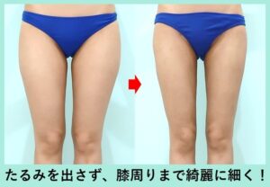 太もも＋下臀部＋膝まわりの脂肪吸引のビフォーアフター