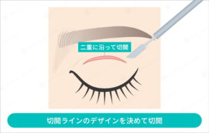 まぶたの表面を切開しているイラスト