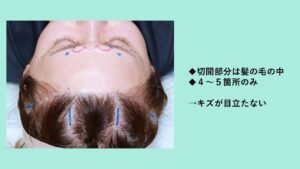 頭にマーキングされた女性の頭頂部