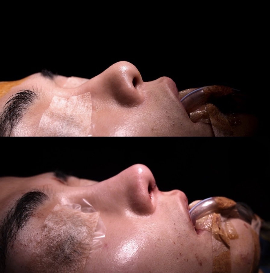 『【男性らしい鼻とは何か?】 初回鼻整形でつくる“かっこいい”の本質』の画像