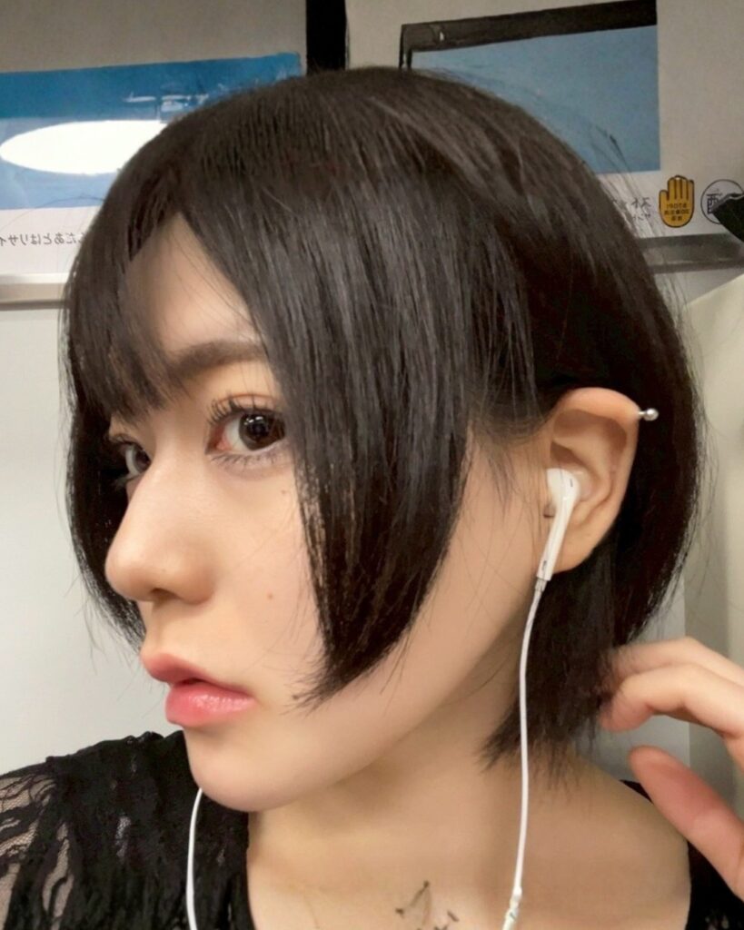 骨切り×WOM式小顔術 AFTER写真