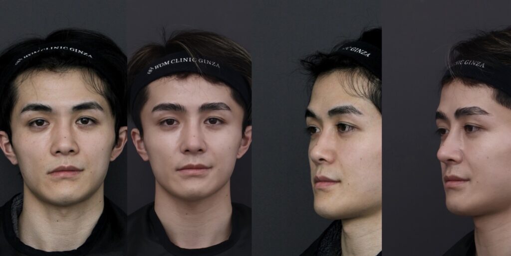 『【男性らしい鼻とは何か?】 初回鼻整形でつくる“かっこいい”の本質』の画像